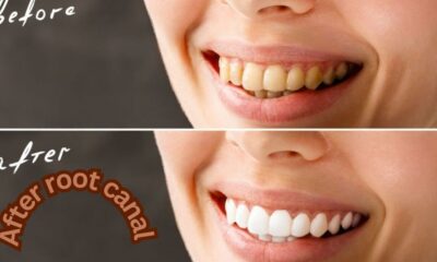 Root Canal Before and After