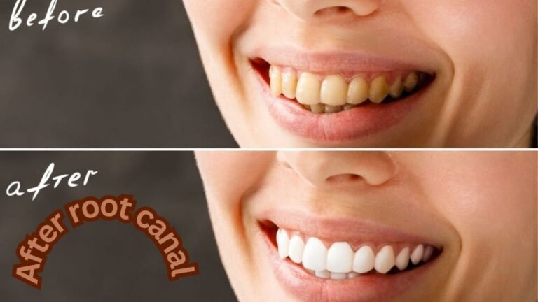 Root Canal Before and After: Restoring Your Smile 6 Root Canal Before and After