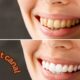 Root Canal Before and After