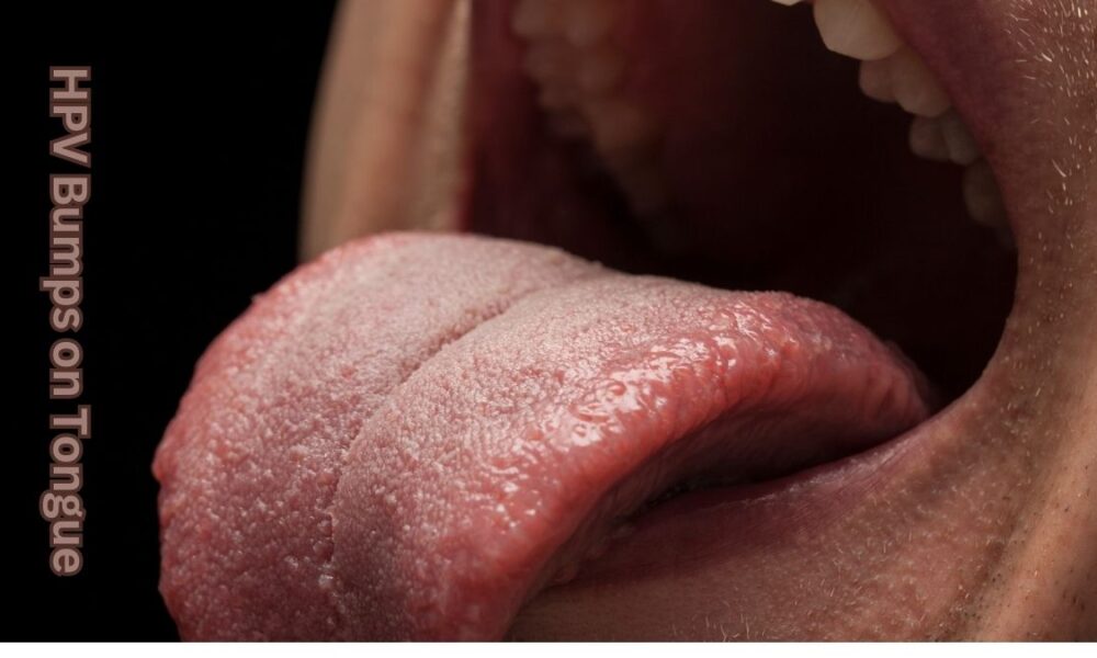 HPV Bumps on Tongue: