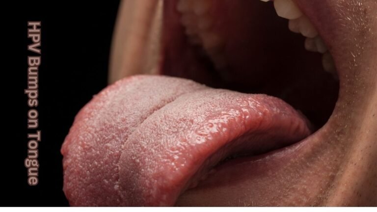 HPV Bumps on Tongue: Causes, Symptoms, and Treatment 6 HPV Bumps on Tongue: