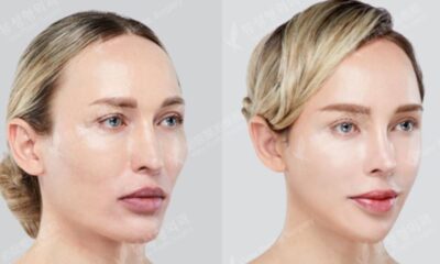 Nose Aquiline