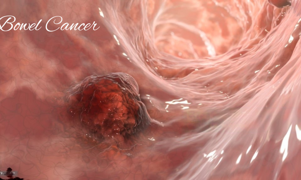 Bowel Cancer