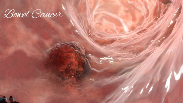 Bowel Cancer