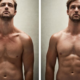 CoolSculpting Before and After
