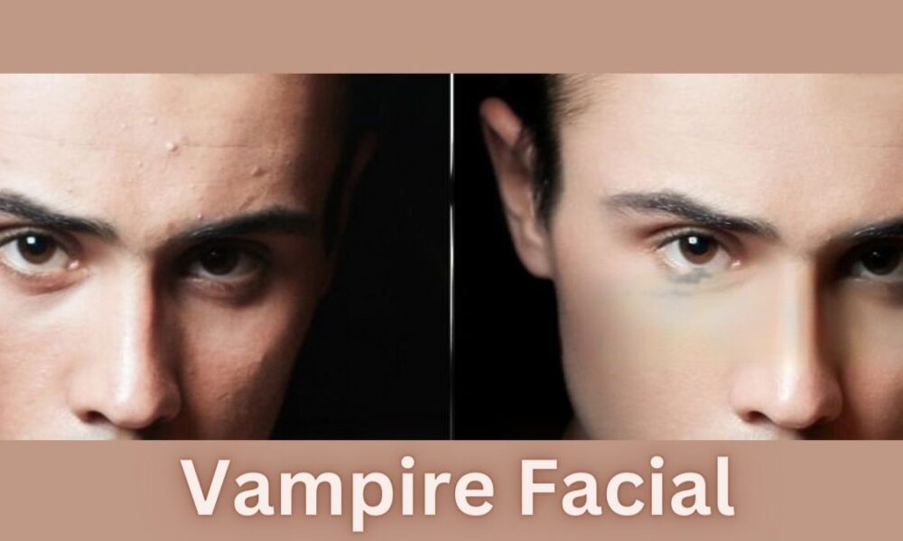 Vampire Facial