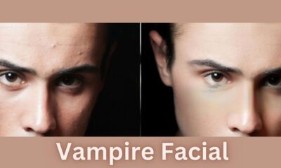 Vampire Facial