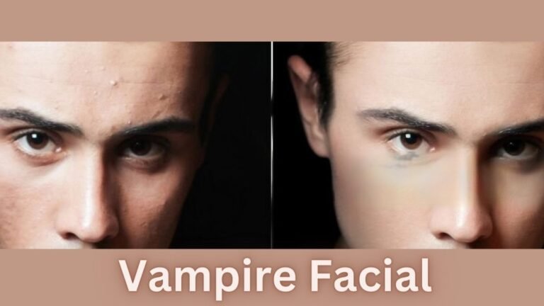 Vampire Facial