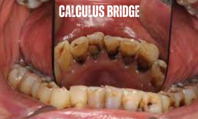 Calculus Bridge