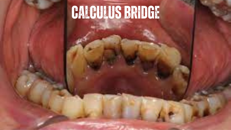 Calculus Bridge