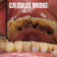 Calculus Bridge
