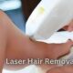 Laser Hair Removal