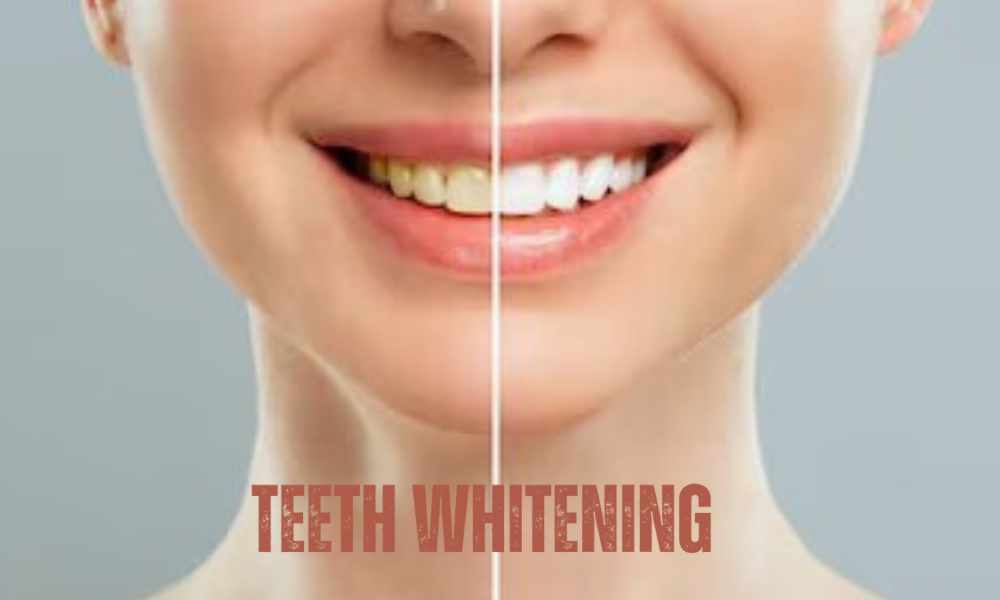 Teeth Whitening