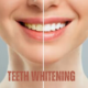 Teeth Whitening