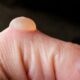 Blisterata